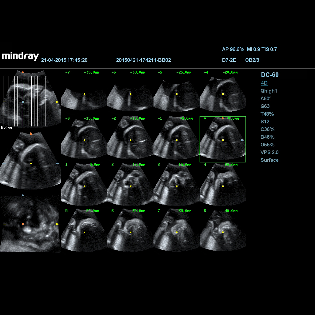 iPage™ - Софтуер за ехограф Mindray