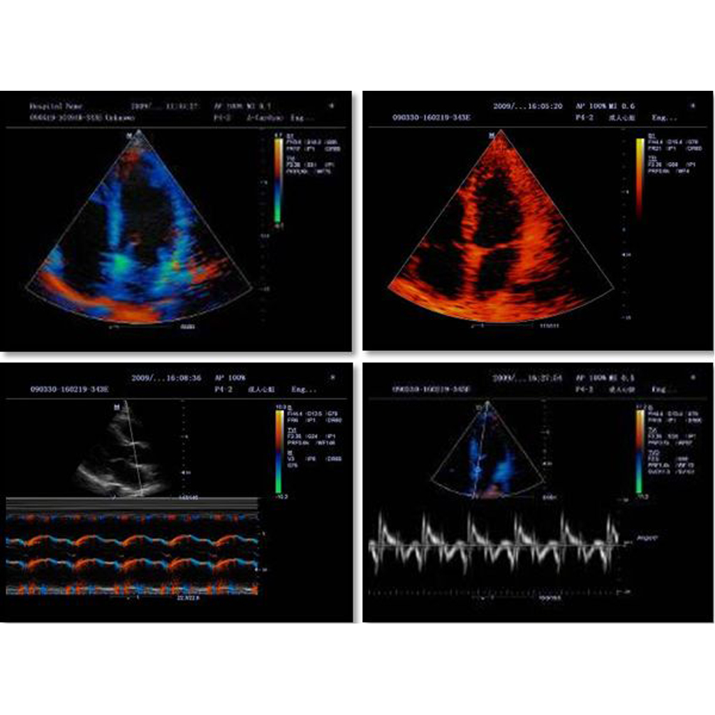 TDI (Tissue Doppler Imaging, includes TVI, TEI, TVD and TVM) - Софтуер за ехограф Mindray