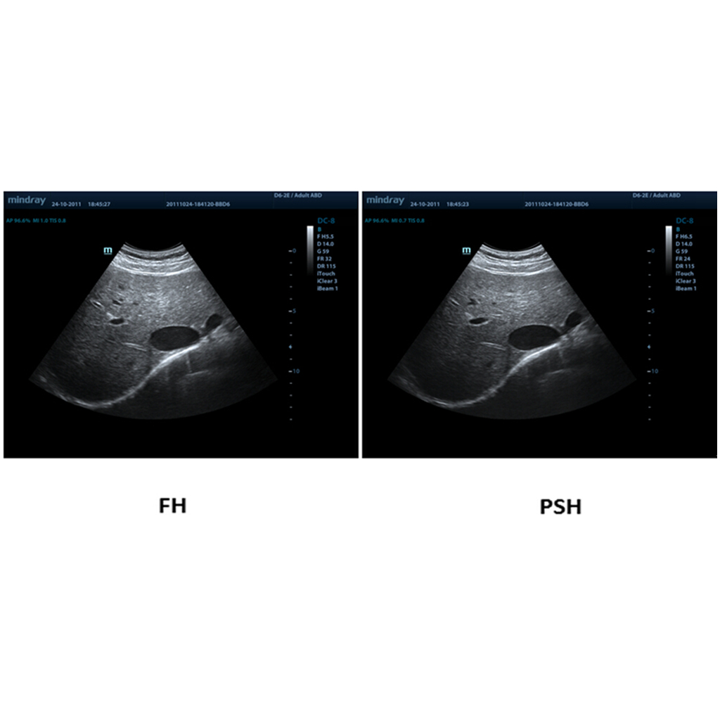 PSH™ (Phase Shift Harmonic Imaging)