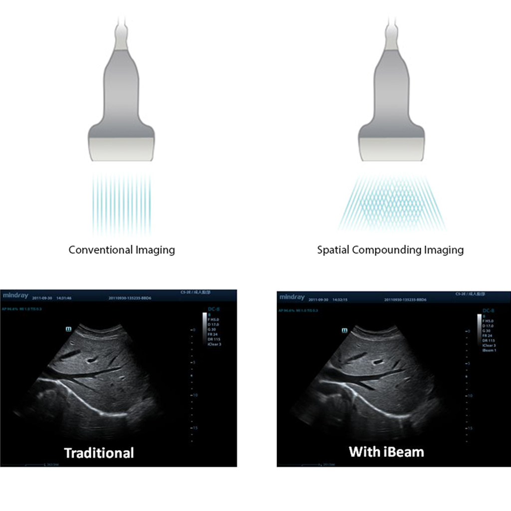 iBeam™ (Spatial Compounding Imaging) Mindray Veterinary Ultrasound Software