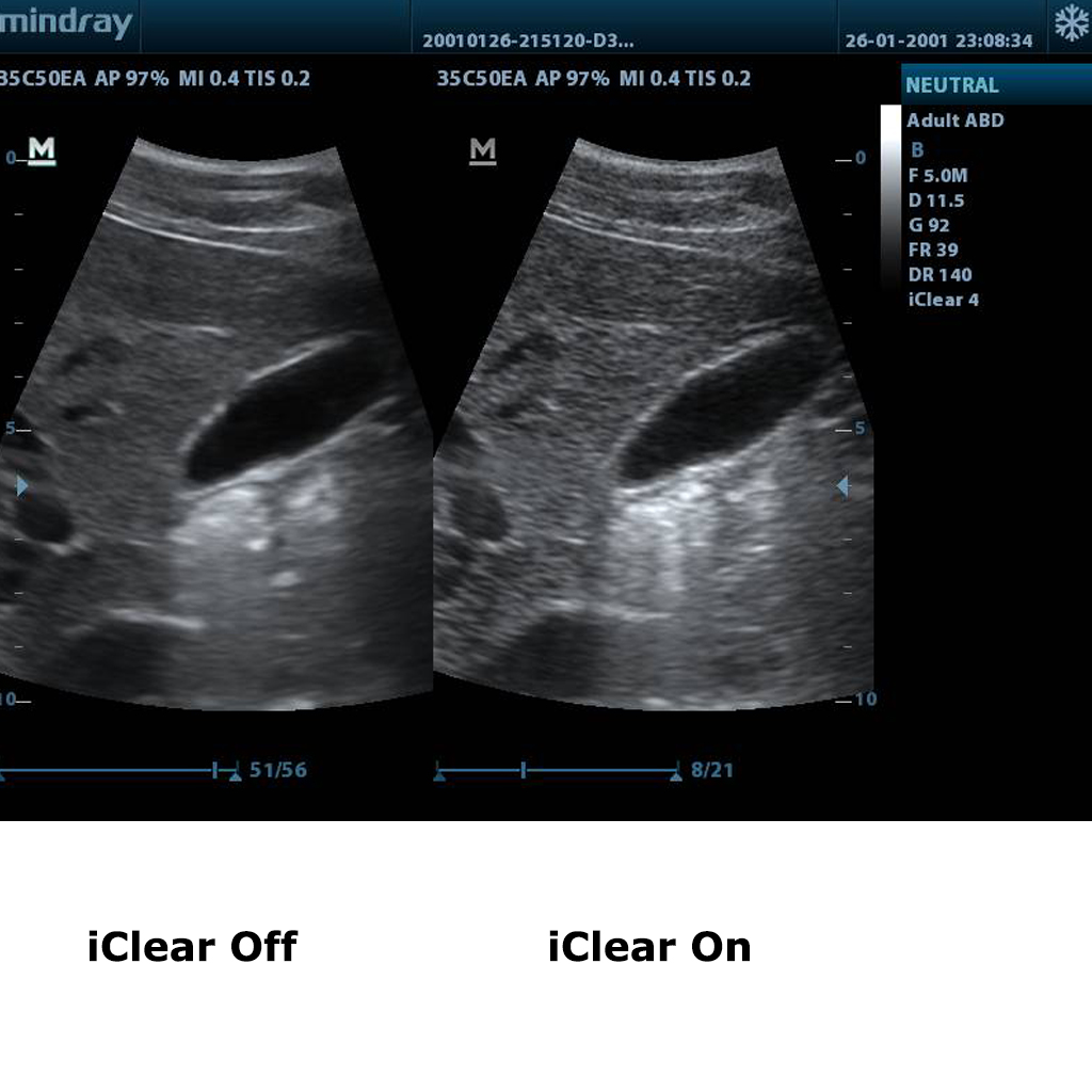 iClear™ (Speckle Suppression Imaging) (копие)