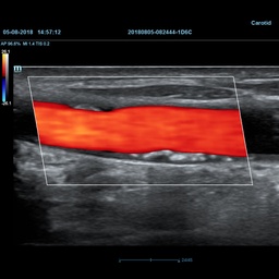 [119061682] iWorks™ (Standardized Workflow Protocol) - Mindray Ultrasound Software